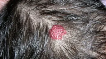 فطريات الشعر