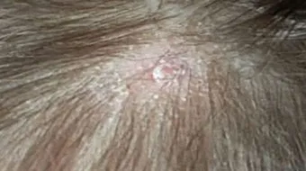 علاج فطريات الشعر