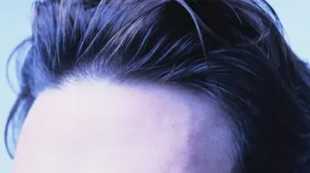 إنبات الشعر