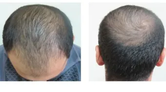 مراحل نمو الشعر بعد الزراعة