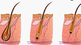 مراحل نمو الشعر