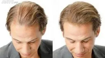 حلول لعلاج تساقط الشعر