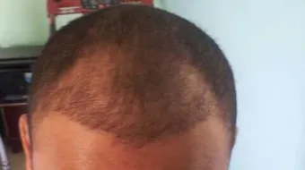 طرق تكثيف الشعر من الأمام