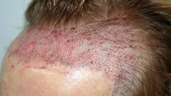 مراحل زراعة الشعر