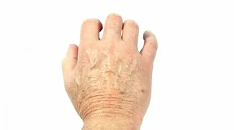 علاج تشقق اليدين