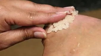 علاج تشقق الكعب