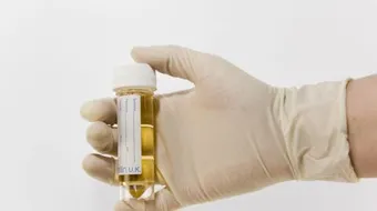 ارتفاع الزلال في البول