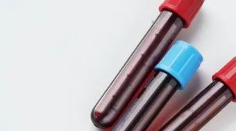 ارتفاع الكالسيوم في الدم