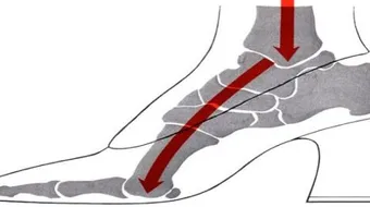 الكعب العالي وأضراره