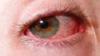 ارتفاع ضغط العين