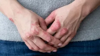 ارتفاع حمض اليوريك