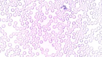 ارتفاع عدد كريات الدم البيضاء