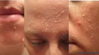 طرق تقشير الوجه في البيت