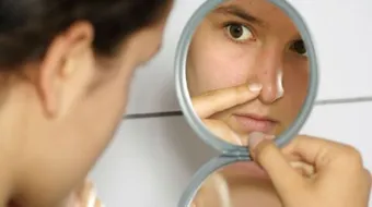 كيف يزول حب الشباب