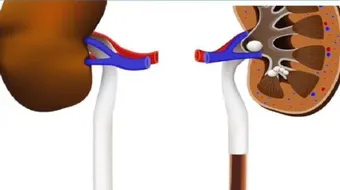 كيف تتكون حصى الكلى