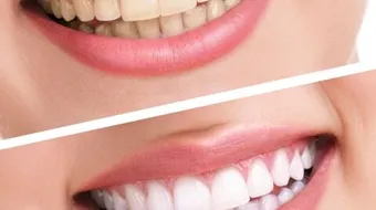 كيف يمكننا تبييض الأسنان