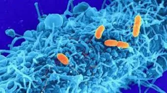 كيف بدأ مرض الايدز