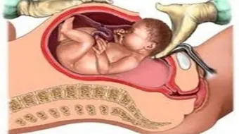 كيف أتجنب الولادة القيصرية