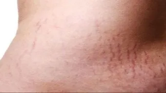 كيف أتجنب تشققات البطن في الحمل