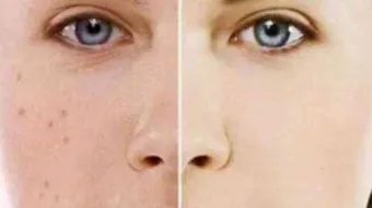 كيف أنظف بشرتي من الحبوب