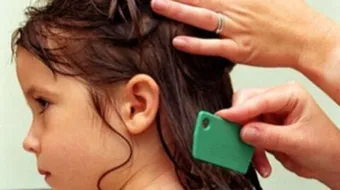 كيف أقضي على قمل الشعر