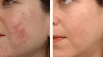 كيف أقضي على آثار حب الشباب