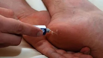 كيف اخرج زجاجة من قدمي