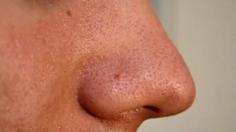 كيف أتخلص من حب الشباب والرؤوس السوداء