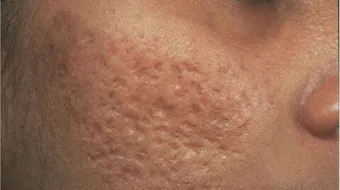 كيف أتخلص من حفر حب الشباب