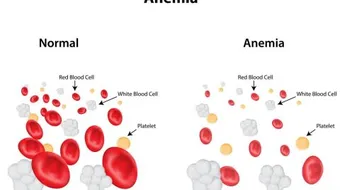 كيف أتخلص من فقر الدم