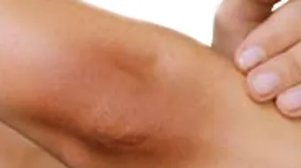 كيف أتخلص من سواد الركب والأكواع