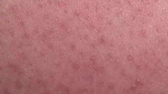 كيف أتخلص من جلد الدجاجة