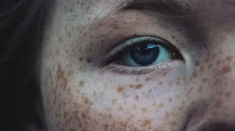 كيف أتخلص من الكلف