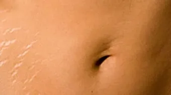 كيف أتخلص من تشققات الجسم