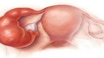 كيف أتخلص من التكيس