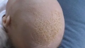كيف أتخلص من قشرة رأس الرضيع