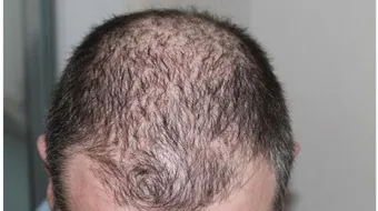 كيف أتخلص من القشرة وتساقط الشعر