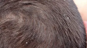 كيف أتخلص من قشرة الشعر والحكة