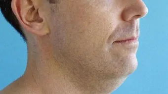 كيف أتخلص من دهون الوجه