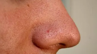 كيف أتخلص من الدهون في الوجه