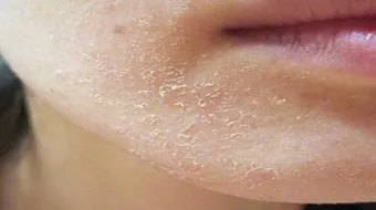 كيف أتخلص من قشور الوجه