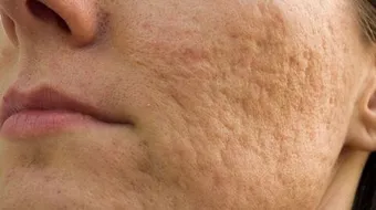 كيف أتخلص من بقع الحبوب