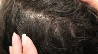 كيف أتخلص من قمل الشعر