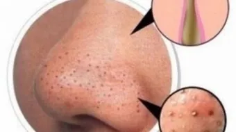 كيف أتخلص من الشعر تحت الجلد