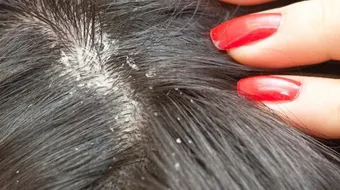 كيف أتخلص من بيض القمل