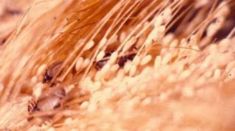 كيف أتخلص من القمل نهائياً