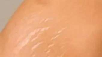 كيف أتخلص من تشققات الحمل