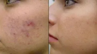 كيف أتخلص من آثار الحبوب