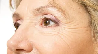 كيف أتخلص من التجاعيد تحت العين