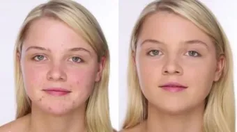 كيف أخفي الحبوب